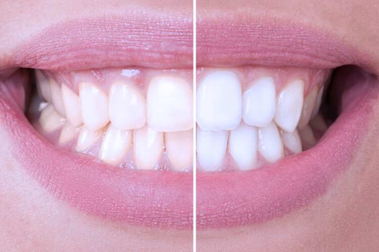 teeth whitening result representation